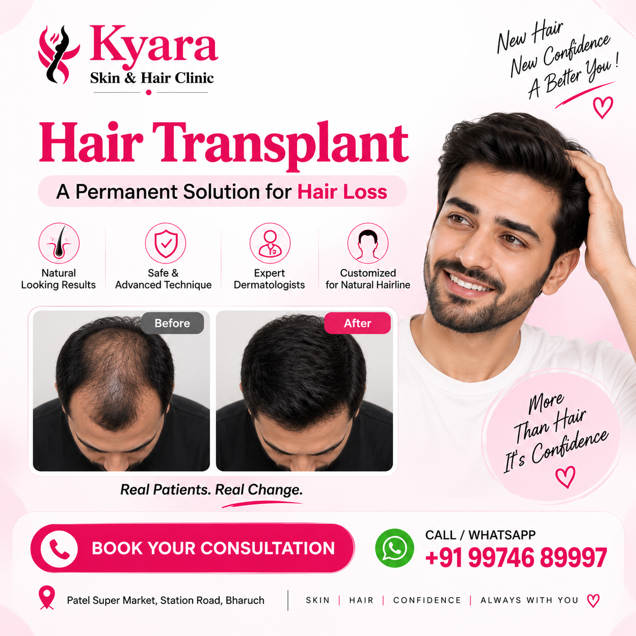 Hair Transplant FUE Permanent Solution