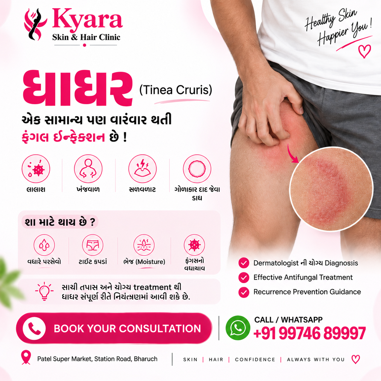 Tinea Cruris Symptoms and Treatment